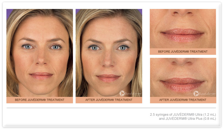 Juvederm Before and After